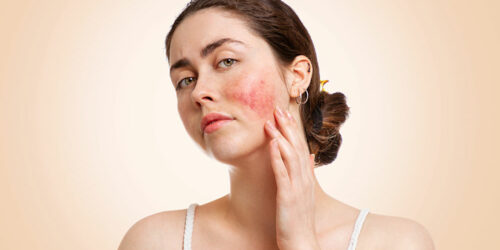 Type of rosacea and how the skin condition can be treated