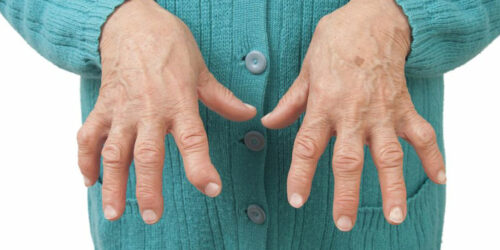 Types of arthritis and ways to deal with them