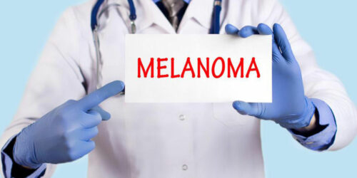 Understanding metastatic malignant melanoma