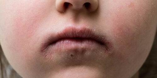 Understanding the causes of impetigo in children and adults