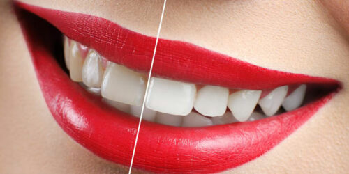 Yellow Teeth &#8211; How to avoid discoloration of teeth