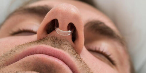 10 Things You Need to Know about Anti Snoring Devices