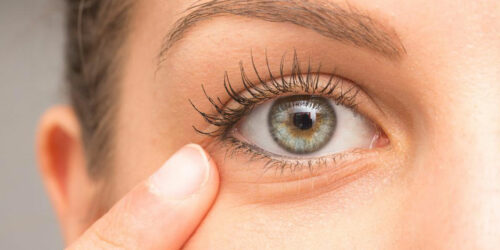 10 Tips to Remove Under-Eye Bags