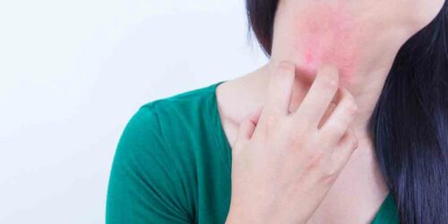 10 over-the-counter treatments for eczema that offer better results