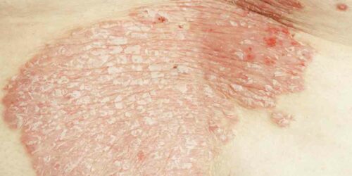 7 Common Types of Eczema