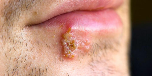 7 Tips for Treating Cold Sores