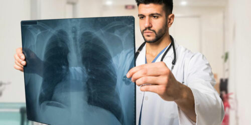 4 Common Treatment Options for Lung Cancer