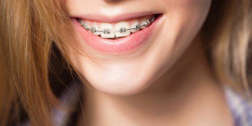 4 common types of teeth braces for adults