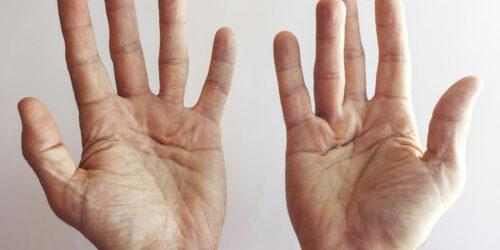 4 hand exercises for Dupuytren&#8217;s contracture patients