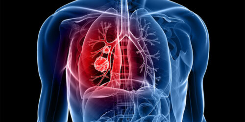 5 cities with the highest rates of lung cancer