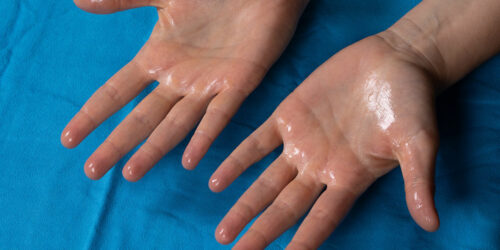 5 effective tips to manage hyperhidrosis