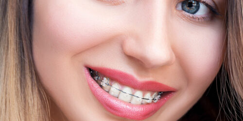 5 things you should know before you get braces