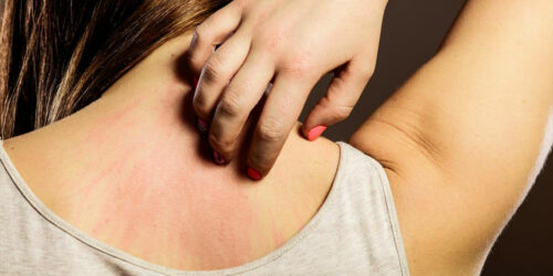 6 Natural Ways for Instant Relief from Itchy Skin