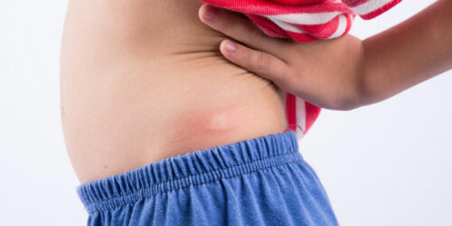 6 Daily Activities That Help In Shingles Rash Treatment