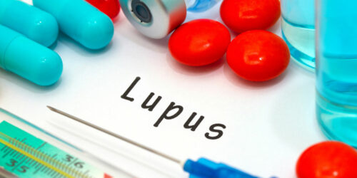 9 Early Signs and Symptoms of Lupus