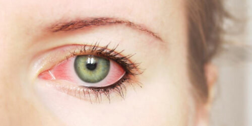 Common Causes and Treatments for Red Eye