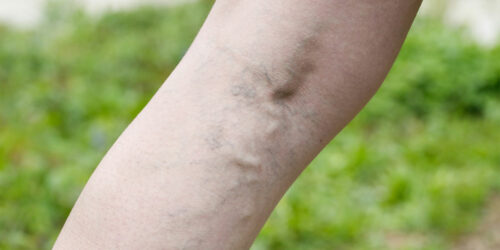 Common Symptoms and Treatments for Varicose Veins