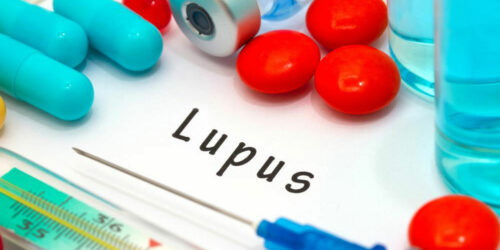 Common Treatment Options For Controlling Lupus