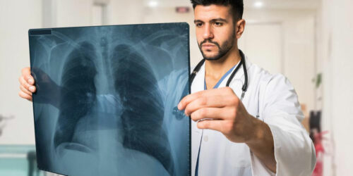 Common pulmonary embolism symptoms that you should be aware of