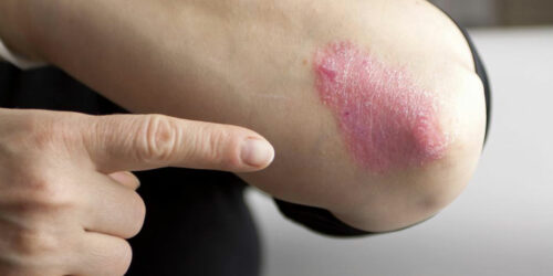 Chronic Plaque Psoriasis And its Effective Treatment