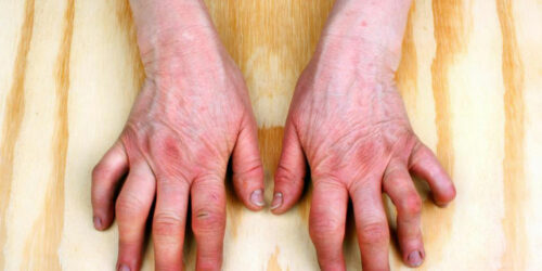 A Brief Overview of Rheumatoid Arthritis