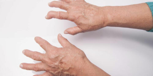 A Quick Guide of Rheumatoid Arthritis Drugs