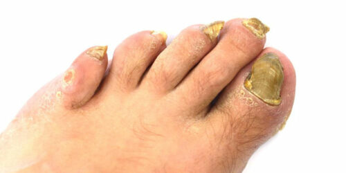 An Effective Way to Treat Toenail Fungus &#8211; Hydrogen Peroxide