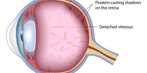 All About Eye Floaters And How To Get Rid Of Them