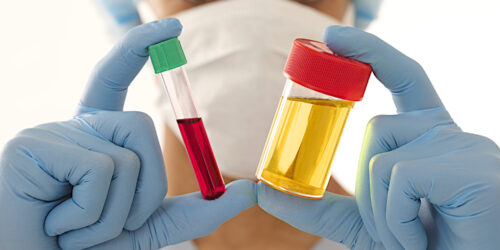 All You Need To Know About Blood In Urine