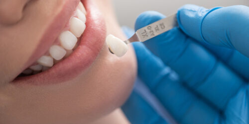 All you need to know about dental crowns and caps