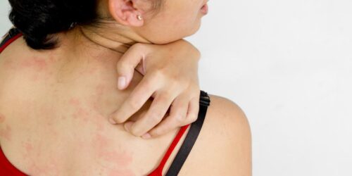 Atopic Dermatitis- Causes, Symptoms And Treatment