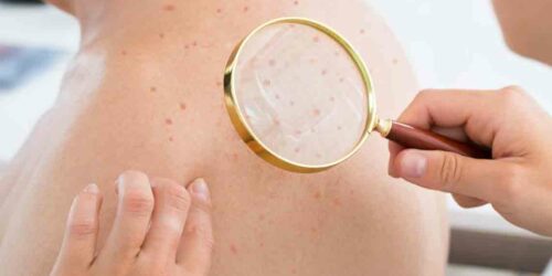 Atopic Dermatitis Eczema &#8211; Causes, Symptoms, and Treatments