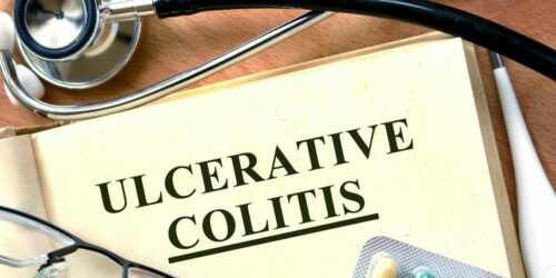 Beating Ulcerative Colitis Flares