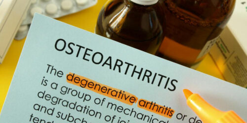 Best Treatment Options for Osteoarthritis of the Knee