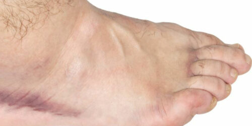 Get Easy Relief from Your Swollen Ankle