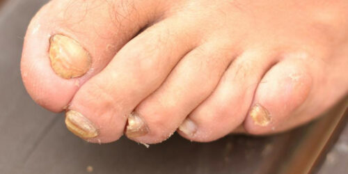 Get Rid of Toenail Fungus Quickly with 6 Home Remedies