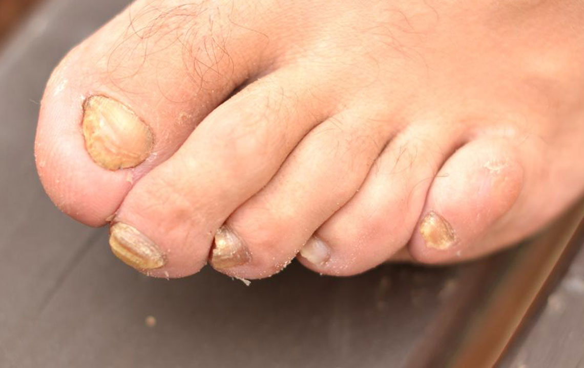 Get Rid of Toenail Fungus Quickly with 6 Home Remedies