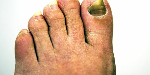 Get Rid of Toenail Fungus With the Right Treatment