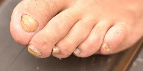 Get rid of toenail fungus with these home remedies