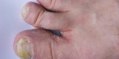 Guide to Treating Toenail Fungus