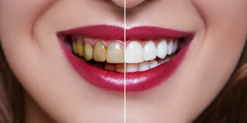 Dental veneers&#8217; cost, procedure, and results