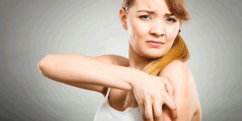 Diet Plans for Controlling the Symptoms of Eczema