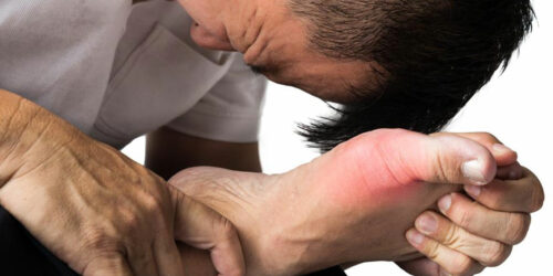 Different Treatment Plans for Gout Pain Relief and Prevention of Gout Attacks