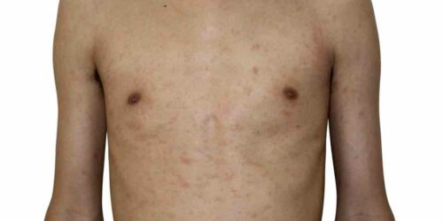 Different Types of Pityriasis Rosea Treatments