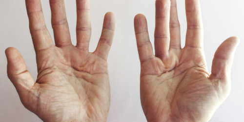 Dupuytren’s Contracture &#8211; Its Symptoms and Causes