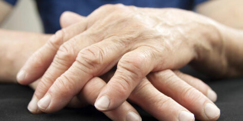 Easy Ways to Manage Psoriatic Arthritis