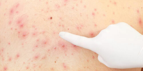 Effective Remedies for Treating Skin Rashes