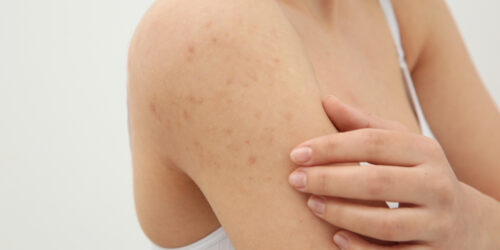 Everything You Need To Know About Hiv Skin Rash