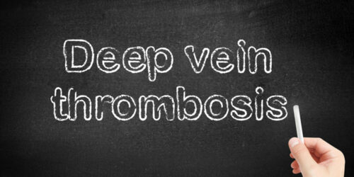 Everything to Know about Deep Vein Thrombosis