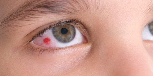 Eye infections &#8211; All you need to know